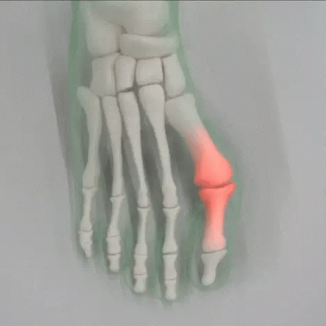 Fotreglage™ - Slipp operationen och lindra smärtan på 7 dagar