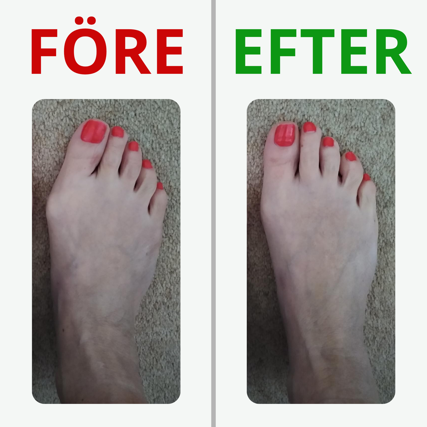 Fotreglage™ - Slipp operationen och  lindra smärtan på 7 dagar