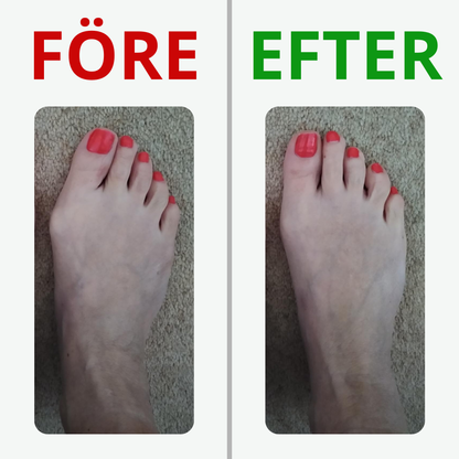 Fotreglage™ - Slipp operationen och  lindra smärtan på 7 dagar