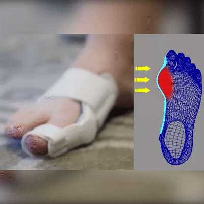 Fotreglage™ - Slipp operationen och  lindra smärtan på 7 dagar